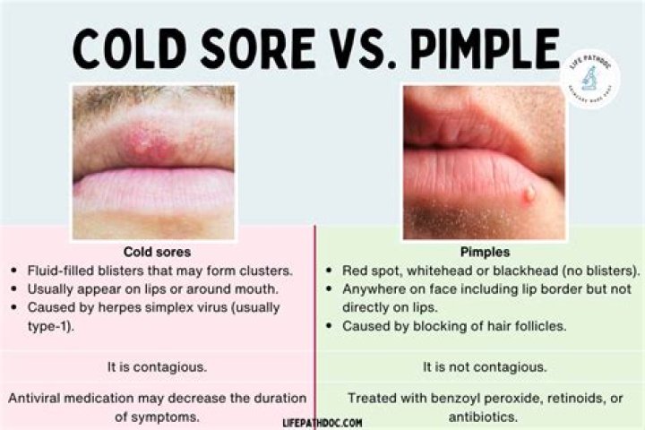 Cold Sores Like Pimples: Understanding, Treating, and Managing Them Effectively