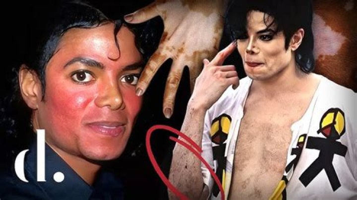 Did MJ Have Vitiligo? Unveiling the Truth Behind Michael Jackson's Skin Condition
