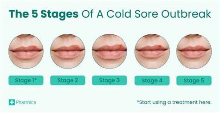 Should Cold Sores Blister Be Popped? A Comprehensive Guide