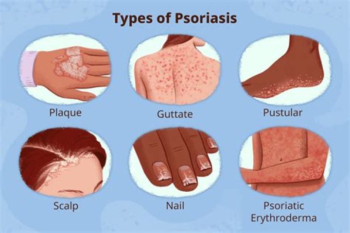 Understanding Psoriasis in Ears Pictures: A Comprehensive Guide