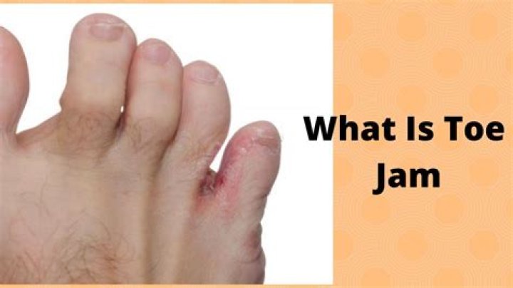 What's Toe Jam: Understanding the Causes, Prevention, and Treatment