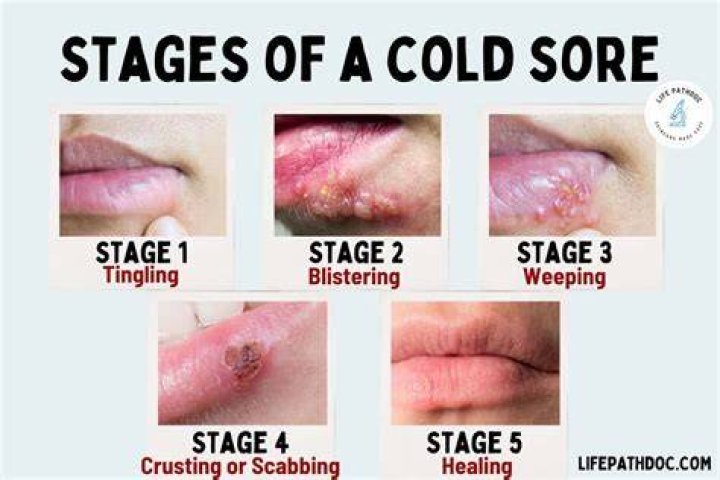 What Happens If You Pop Cold Sores? Understanding the Risks and Consequences